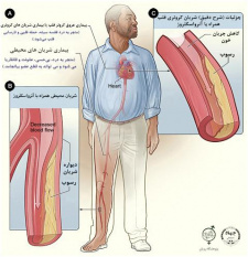 امکان تشخیص زودهنگام بیماری شریان محیطی (PAD) در کلینیک دیابت پژوهشگاه رویان جهاد دانشگاهی